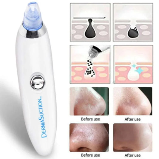 Derma Suction – Pore Cleaner & Blackhead Remover