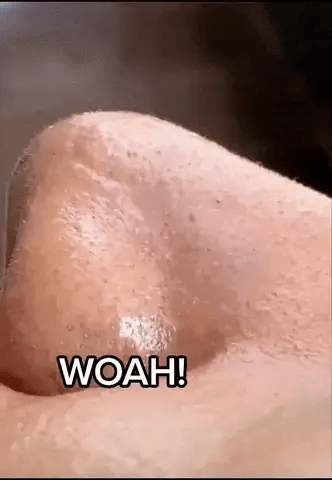 Derma Suction – Pore Cleaner & Blackhead Remover